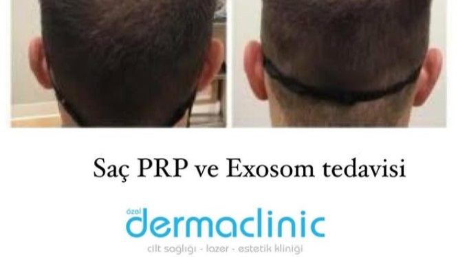 Bursa'da Saç Mezoterapisi ile Güçlü ve Canlı Saçlara Kavuşun – Dermaclinic Farkıyla