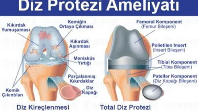 Diz Protezi Tedavisi Hakkında Bilmeniz Gereken Her Şey