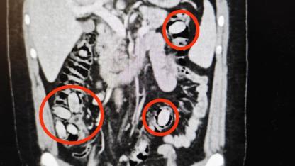 Midesinde taşıdığı uyuşturucu maddeler polisin dikkatinden sayesinde ele geçirildi